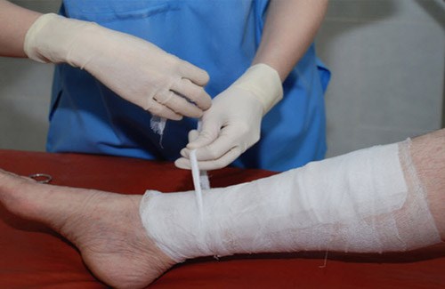 лечение трофических язв на ногах