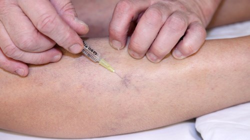 cum se trateaza în europa varicoza cum de a vindeca varicarea pe picioare