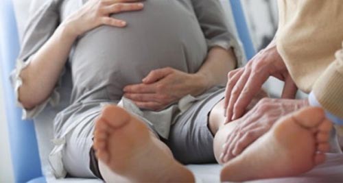 Варикоз у женщин при беременности