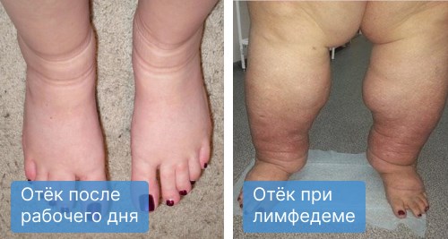 Отеки ног - причины появления, при каких заболеваниях возникает, диагностика и способы лечения