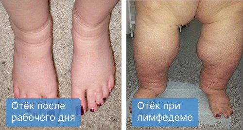 Разница отеков Разница отеков
