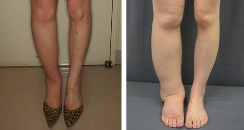 Чем опасны лимфатические отёки ног? Лимфостаз нижних конечностей