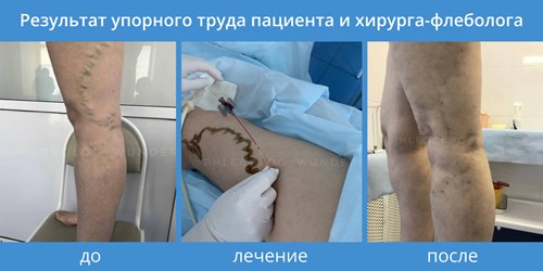 результат лечения варикоза результат лечения варикоза