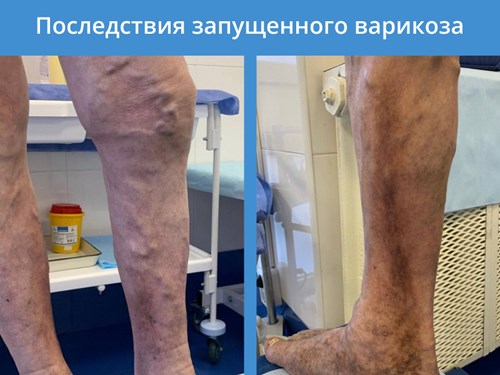 последствия запущенного варикоза последствия запущенного варикоза