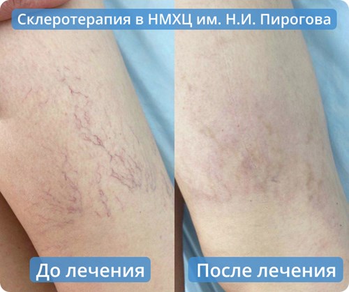 склеротерапия-1.jpg?width=500&height=418.99441340782124